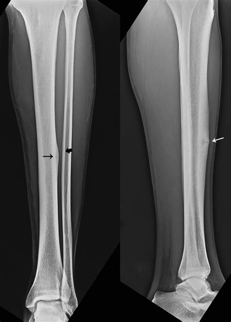 Diagram Diagram Of Tibia Stress Fracture Mydiagramonline