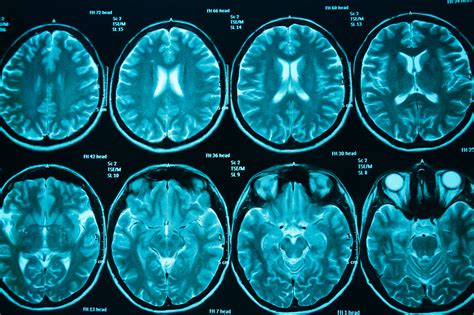 Imaging Agent Could Reveal Chronic Traumatic Encephalopathy In Living