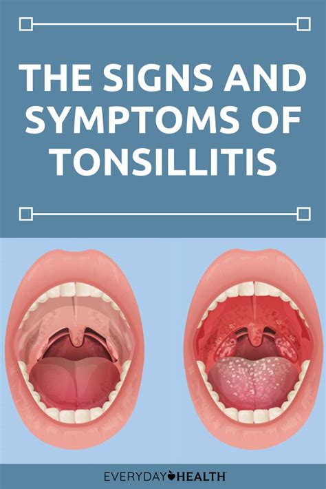 What Does Oral Thrush Look Like On Tonsils What Does