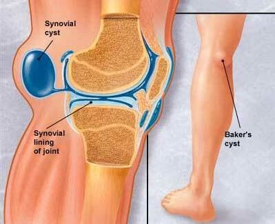 Bakers Cyst Knee Causes Treatment Knee Pain Explained