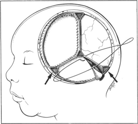 Temporoparietal Craniopagus Journal Of Neurosurgery
