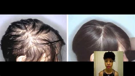 It took forever, but i finally determined that for me, like for many women, iron stops hair loss. Natural Hair Loss Treatment : Check Your Iron Level ...