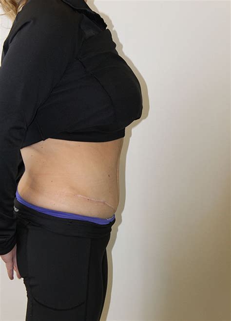 Tummy Tuck Before And After Dikiact