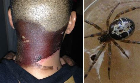 Pictured False Widow Spider Bite Turned My Neck Black Uk News Uk