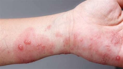 How To Identify Scabies All You Need To Know