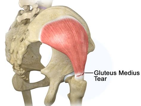 Comparing Gluteus Medius Tendinopathy Injections And Surgery Outcomes