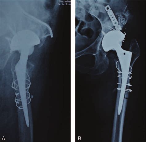 A Anteroposterior And B Lateral Radiographs Of The Left Hip Showing