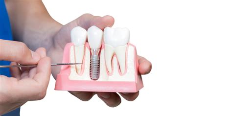 What Does Mini Dental Implant Treatment Involve Mini Dental Implants