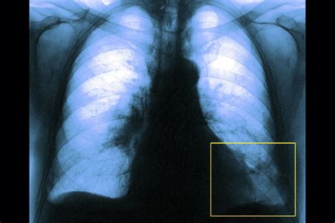 Embolia pulmonar síntomas causas y tratamiento