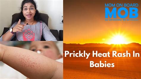 Prickly Heat Rash In Babies How To Prevent And Home Remedies Youtube