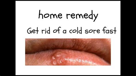 How To Get Rid Of Cold Sores Fast Quick Diy Tips Cold