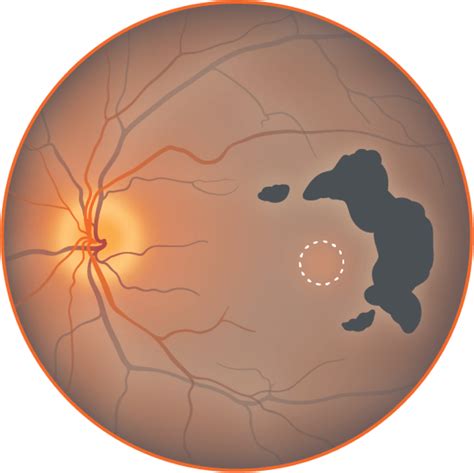 Pre Lesion In Geographic Atrophy Ga An Advanced Form Of Amd