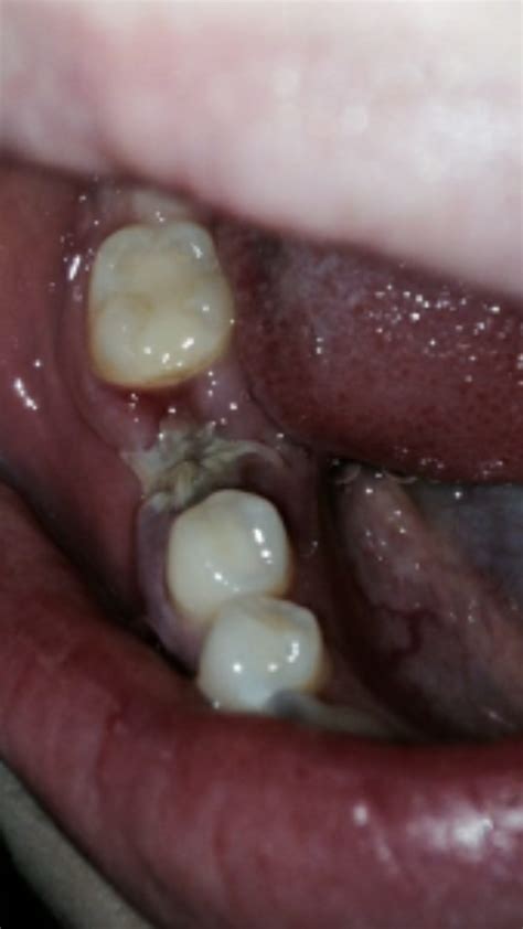 Here Gum Swelling After Tooth Extraction 6 Tooth Bantuanbpjs