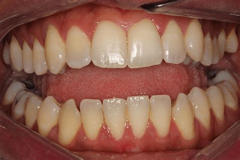 Invisalign Before And After 425 Dental