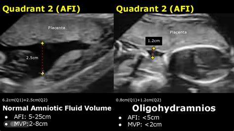 Amniotic Fluid Volume Ultrasound Normal Vs Abnormal Oligohydramnios