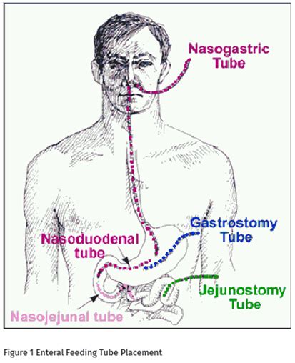 Gastrostomy Transgastricjejunal Jejunal Tube Care