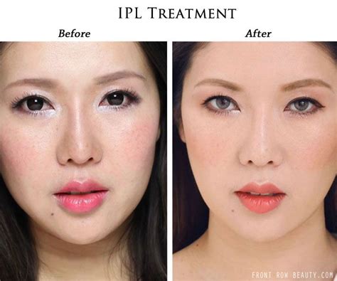 Ipl Face Treatment Before After Doctor Heck