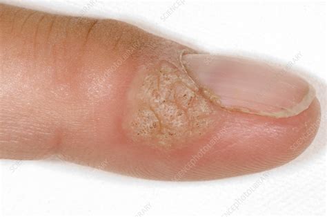 Common Warts Stock Image M Science Photo Library