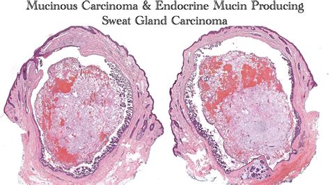 Mucinous Carcinoma And Endocrine Mucin Producing Sweat Gland Carcinoma
