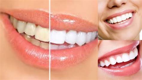 Tips To Achieve Sparkling White Teeth