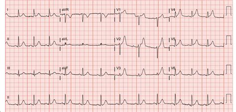 A Case Report Acute Myocardial Infarction In A 29 Year Old Male Emra