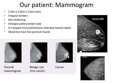 Ppt Case Study 63 Cancer Of The Female Breast Powerpoint