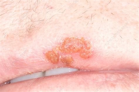Cold Sore Lesion On Upper Lip Stock Image M1700454 Science Photo