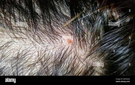 Abscess On Skin Head Stock Photo Alamy