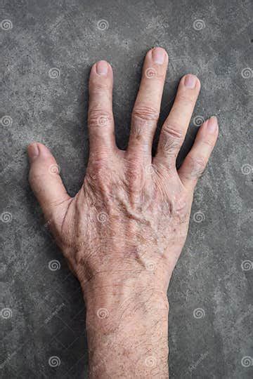 Age Spots On Hand They Are Brown Gray Or Black Spots And Also Called