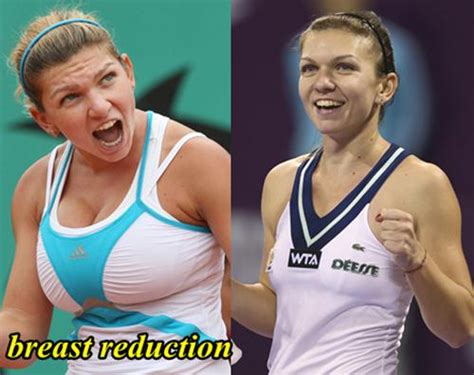 Simona Halep Plastic Surgery Before And After Breast Reduction Photos
