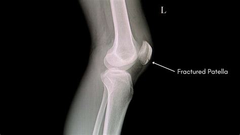 Patella Fracture Classification And Management