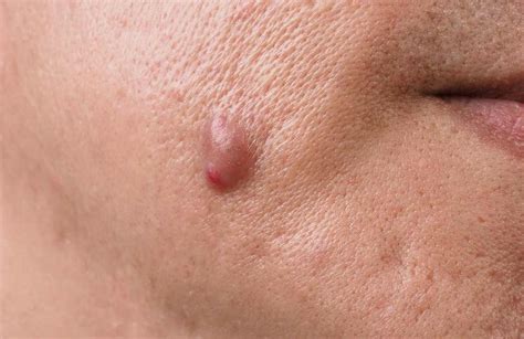 Cystic Acne What It Is Causes And Treatment Ensoul Medical Clinic