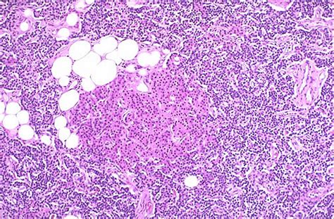 Endocrine Pathology