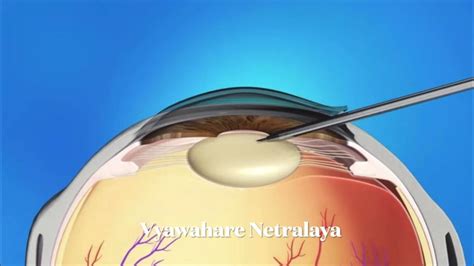 Animated Cataract Surgery Video By Phacoemulsification Youtube