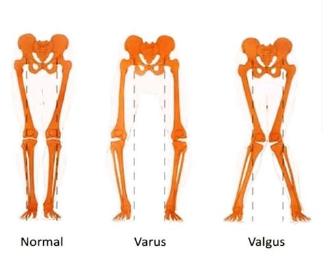 Pathologies Of The Knee Genu Valgum Medical Orthodontia