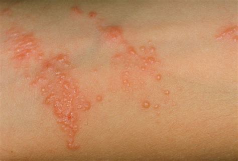 The virus is embedded in the blisters. Common Adult Skin-Problem Pictures: Identify Rashes ...