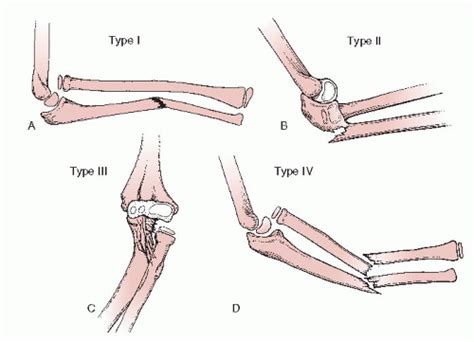 Monteggia Fracture Dislocations Musculoskeletal Key