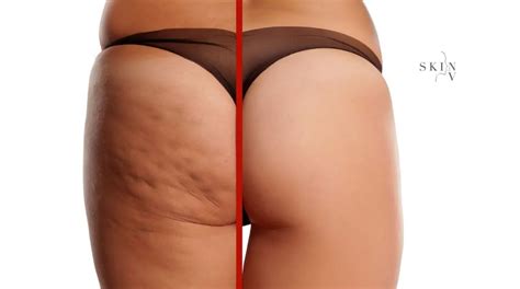 The Truth About Cellulite Causes Prevention Skin NV Clinic