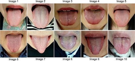 The Power Of Tongue Diagnosis Understanding Common To