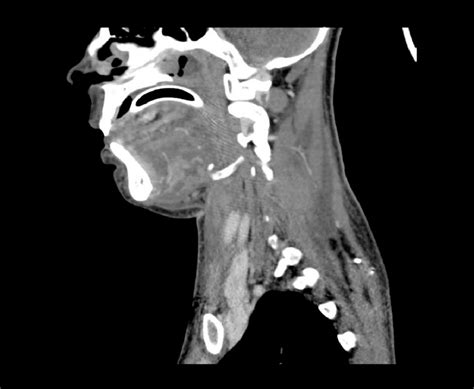 A Ct Scan Of Head And Neck Showing Soft Tissue Swelling And Airway