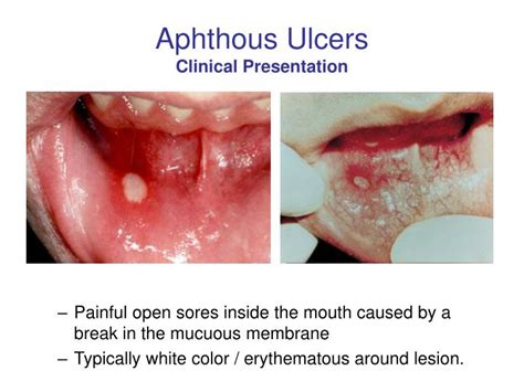 Ppt Oral Medicine Block Presentation Aphthous Ulcers Powerpoint