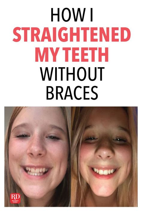 Braces Teeth Braces To Lose Weight