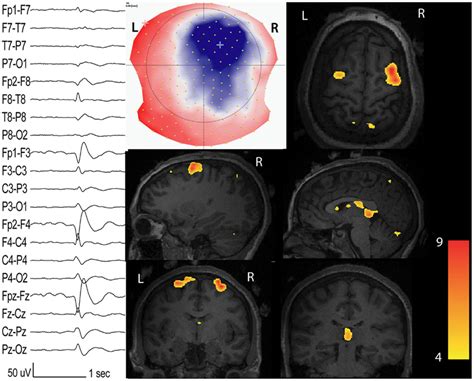 Interictal Network Revealed By Eeg Fmri Patients With Non Lesional