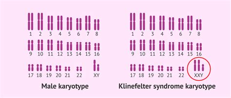 Decodificando El S Ndrome De Klinefelter Y La Infertilidad Masculina