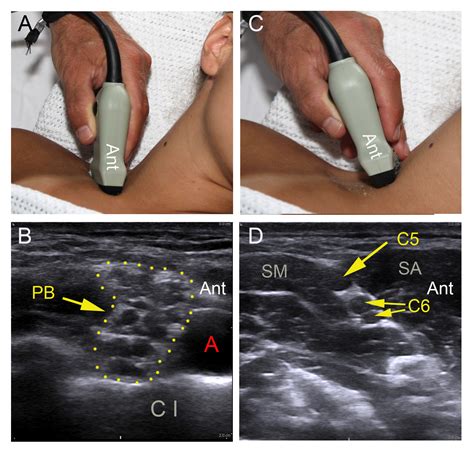 9 How To Perform An Ultrasound Guided Interscalene Brachial Plexus