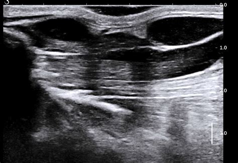 Vietnamese Medic Ultrasound Case 469 T Cell Lymphoma Of Submandibular