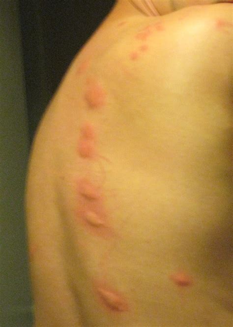 Red Bumps On Back Chicago Illinois Oversharing Where The Heck Is Matt