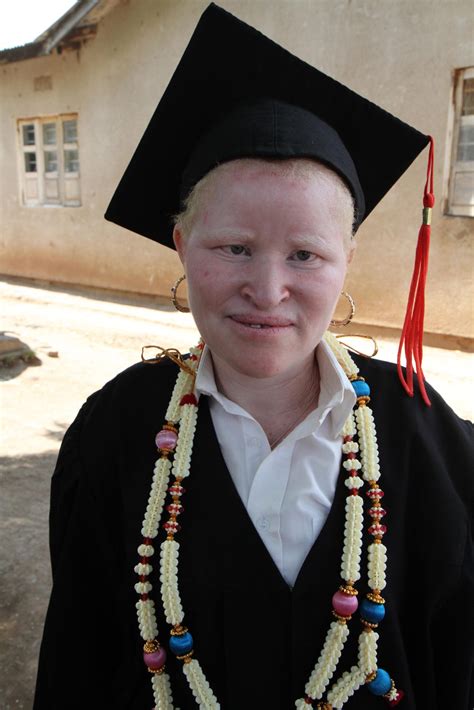 Under The Same Sun Helping People With Albinism