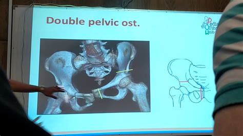 Pelvic Osteotomy Part1 Youtube
