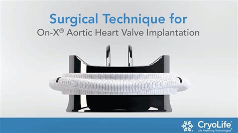 Surgical Technique For On X® Aortic Heart Valve Implantation Cryolife